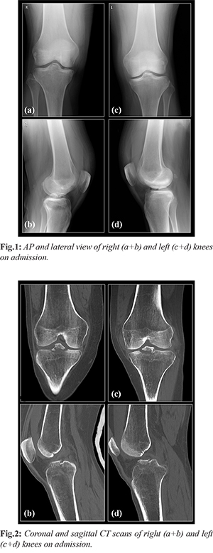 Bilateral Tibial Spine Avulsion Fracture